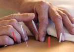 acupuntura-sao-caetano-do-sul-1354794975